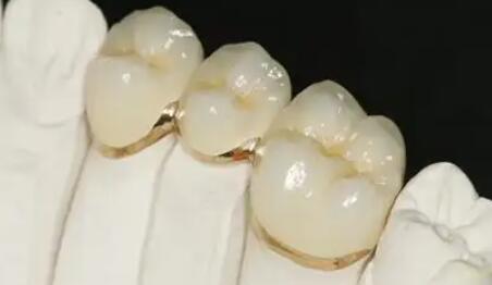 烤瓷牙多少钱一颗？费用贵不贵？快来瞅瞅