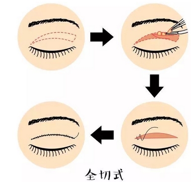 岑瑛双眼皮怎么样？医生团队技术实力怎么样？真实案例可以反映~