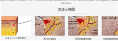 激光溶脂瘦脸多少钱？有哪些注意事项？详情介绍公布！