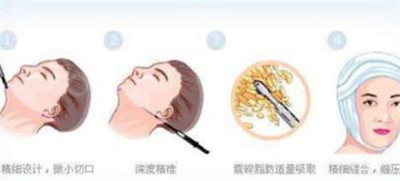 激光溶脂瘦脸多少钱？有哪些注意事项？详情介绍公布！