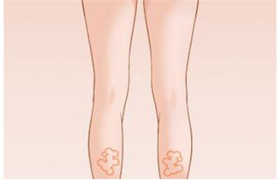 小腿吸脂安全吗?吸脂后影响走路吗?