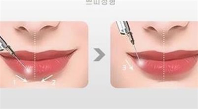 玻尿酸丰唇需要多少钱?能维持多久的时间?