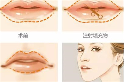 玻尿酸丰唇需要多少钱?能维持多久的时间?