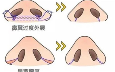 隆鼻手术多久恢复自然，隆鼻手术存在风险吗？