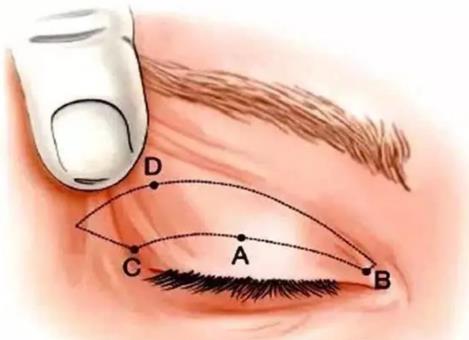 上睑皮肤松弛矫正的方法有哪些？双眼皮和切眉那种效果好？术后护理方式有哪些？