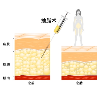 武汉协和郭科抽脂怎么样？口碑好吗？医生信息简介-大腿抽脂病例！