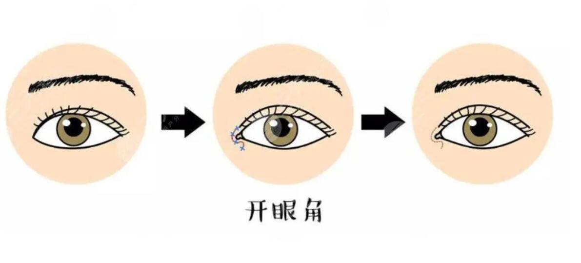 开个眼角和做卧蚕需要多少钱?适合哪些人做?戳进来看详细介绍