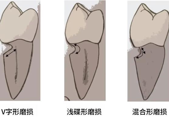 牙颈部楔状缺损怎么办？补牙后一般能维持几年？