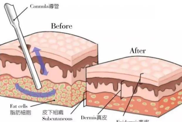 产后减肥人气方法是什么？水动力吸脂的步骤介绍！