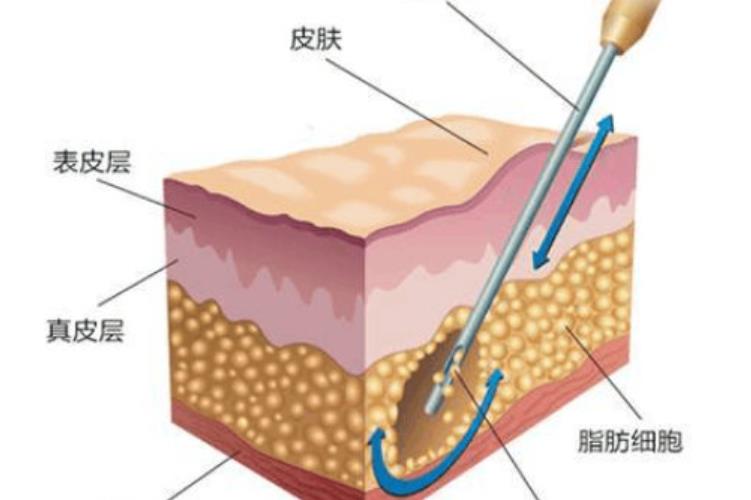 产后减肥人气方法是什么？水动力吸脂的步骤介绍！