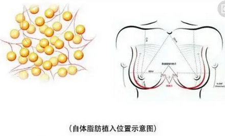 八大处刘春军脂肪隆胸价格如何？隆胸技术好口碑赞！附案例分享~