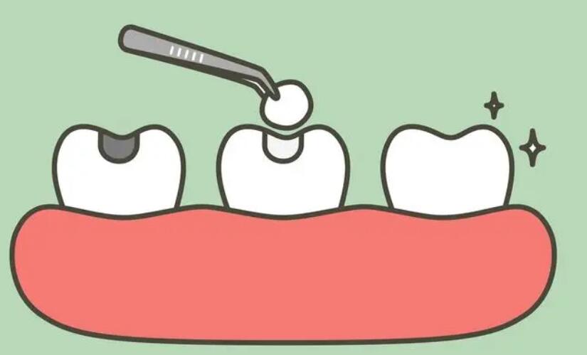 3m光固化树脂补牙寿命是多久？原理及注意事项超全盘点！