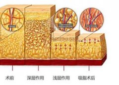 减肥不反弹的方法有哪些？激光溶脂效果好不好？注意事项分享