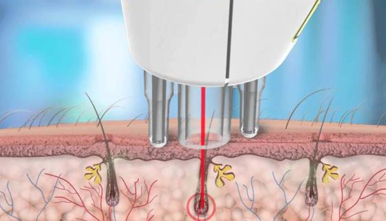 激光脱毛有哪些优势？激光脱毛原理及脱毛前后注意事项介绍！