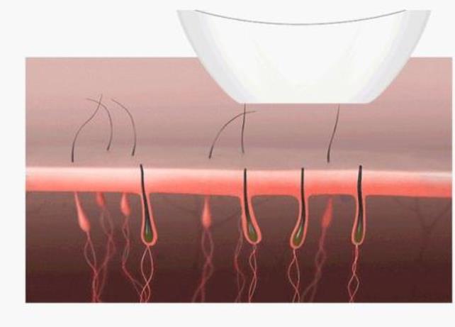 激光脱毛有哪些优势？激光脱毛原理及脱毛前后注意事项介绍！