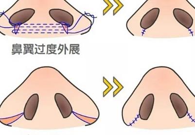 鼻翼缩小的方法，有几个你全了解吗？