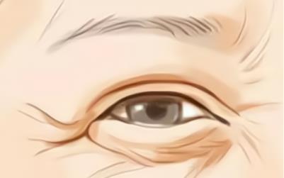 怎样消除眼部皱纹？你知道几各方式，可以进来了解！