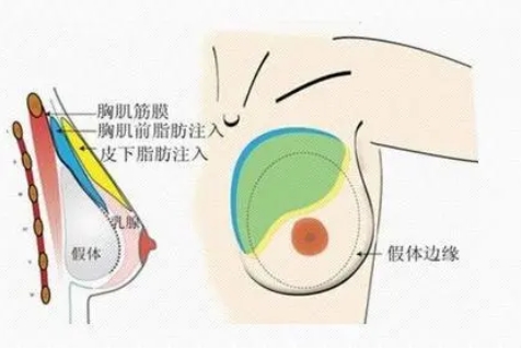 北京八大处刘春军做自体脂肪隆胸多少钱？刘春军医生资料介绍及案例分享！