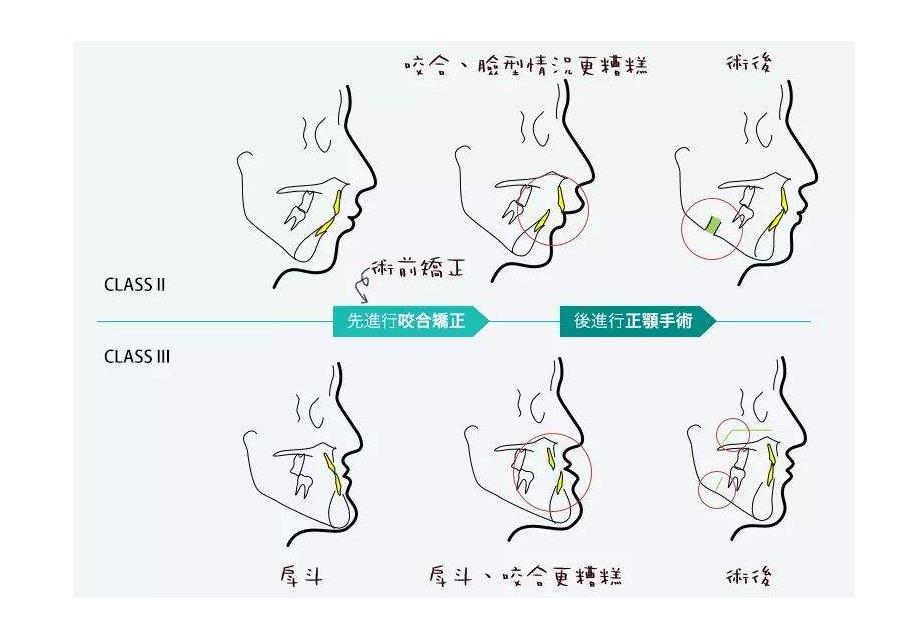 广州时光医院正颌怎么样？费用价格2023_侯振杰医生简介_案例效果