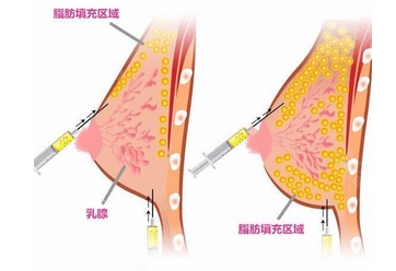 北京八大处刘春军做自体脂肪隆胸多少钱？北京美胸大咖实力揭秘，必看！