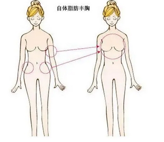 自体脂肪丰胸手术费大概要多少钱？医生从业履历|技术优势点击解锁！