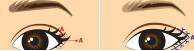 开眼角是开眼头还是眼尾？内附开眼角的手术费用_影响因素！