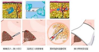 协和医院整形科价位高不高？医院价格表附双眼皮案例展示 