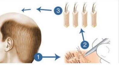 种植头发一般多少钱啊？做完植发后如何护理头皮