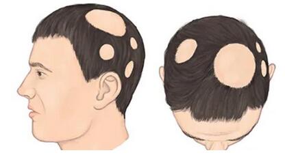 斑秃的原因及调节方法介绍|医疗手段如何调节搬斑秃？