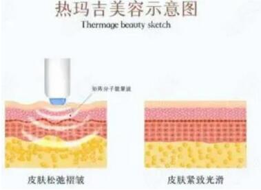 热玛吉有什么果和副作用？术后注意事项看这里！