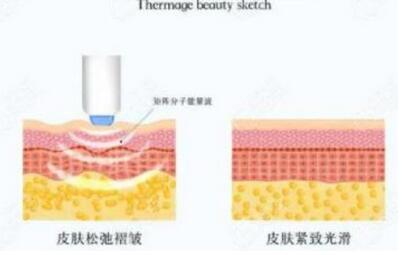 热玛吉有什么果和副作用？术后注意事项看这里！