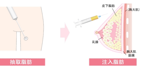 八大处刘春军脂肪隆胸价格如何？这个医生技术好？分享专家|案例信息！