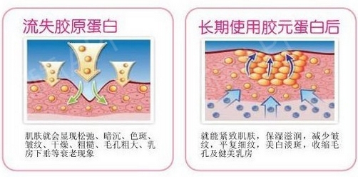 注射胶原蛋白的副作用和注意事项？注射费用及优缺点分析，值得拥有~