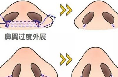 鼻翼肥大怎么办？通过手术调节，非手术调节等等