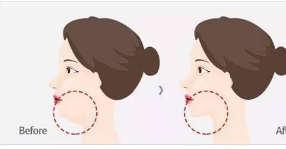 自体脂肪垫下巴价格，受到医生，医院，技术等多种因素!