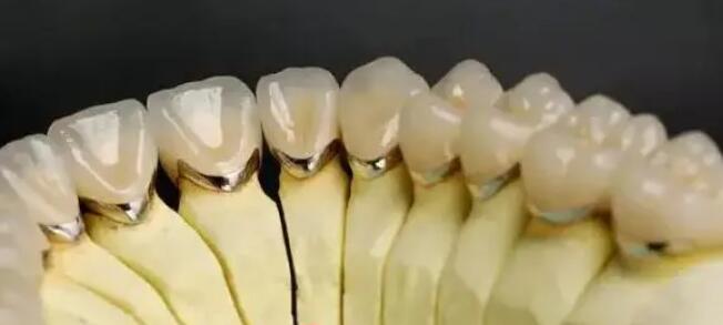 全瓷牙一颗大概多少钱？费用贵不贵？影响因素分析！