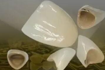 全瓷牙一颗大概多少钱？费用贵不贵？影响因素分析！