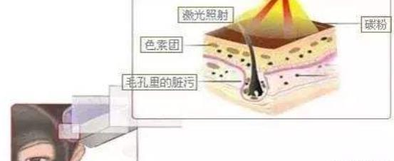 做黑脸娃娃嫩肤怎么样？调节过程是怎么样的？术后注意事项分享