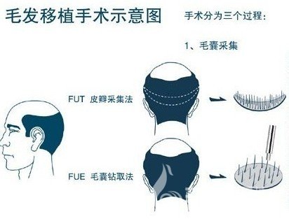 中信惠州医院植发技术怎么样？收费贵吗？黄秋萍医生简介_案例参考！