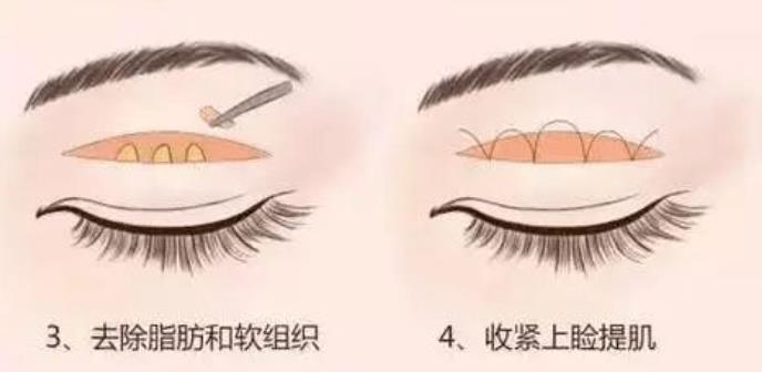 泰安市中心医院美容整形科咋样？聂兆燕vs吴军成谁的技术好？双眼皮案例
