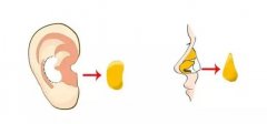 垫鼻尖多少钱一次？鼻尖垫高有哪些方法？材料哪种好？