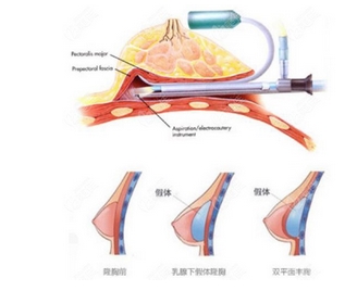 深圳智美秀医疗美容诊所怎么样？这家美容院口碑技术都不错！隆胸整形怎么样呢？