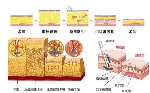 脸部抽脂有什么风险和后遗症？果怎么样？脸部抽脂方面的注意事项！