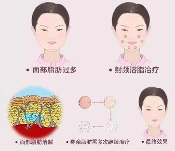 光纤溶脂瘦脸需要戴多久头套？危害、注意事项总结在这里~
