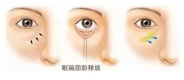 内切眼袋填充泪沟手术后遗症有哪些?手术原理科普!手术要多久恢复?