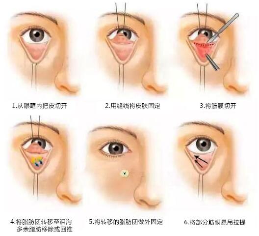 割眼袋要多少钱？有哪些方式？眼周抗衰须知指南~