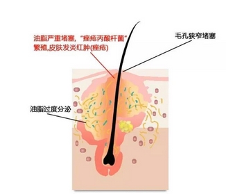 光子对痤疮的作用原理是什么？为什么会长痘痘！该怎么样调理？ 