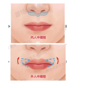 人中缩短术为什么不建议？人中过长的人好吗怎么调整？不是每个人都适合哦！