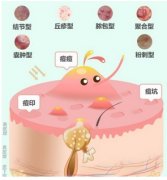 十滴水和甲硝唑凝胶能去粉刺是真的吗？粉刺皮肤的日常护理也很重要！