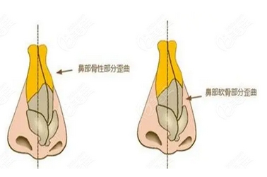 惠州鼻修复好的医生有哪些？洪小芳、曹兴慧、陈虹等，实力不容小觑！